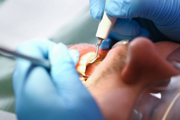 Best Emergency Root Canal Treatment in College Park, GA